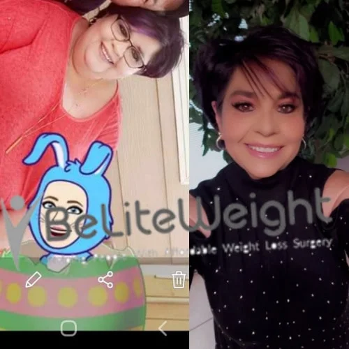 Weight Loss Surgery Gastric Sleeve before and after