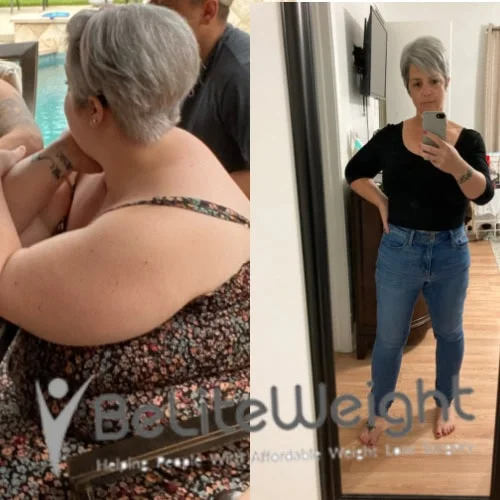 Weight Loss Surgery Before And After