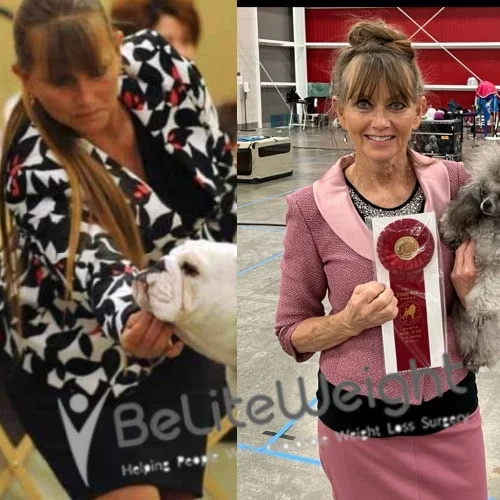 Weight Loss Surgery Before And After