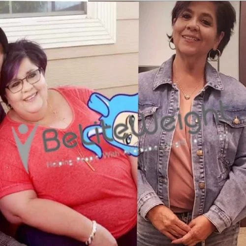 Weight Loss Surgery Before And After