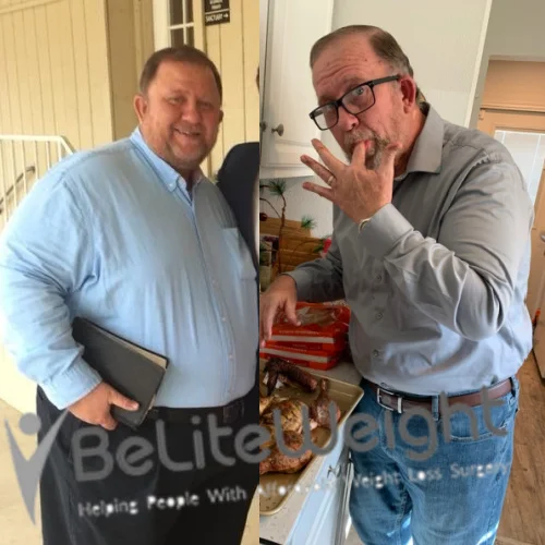 Weight Loss Surgery Gastric Sleeve before and after