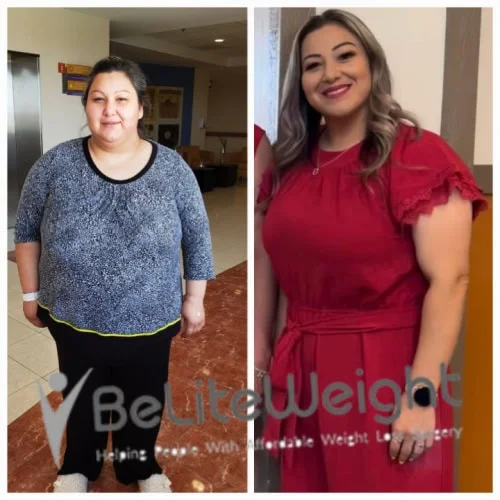 Weight Loss Surgery Before And After
