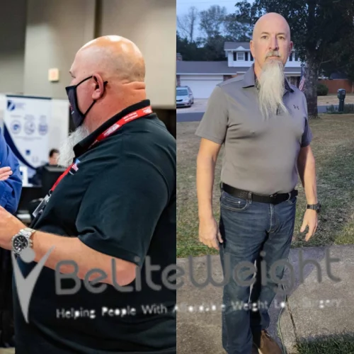 Weight Loss Surgery Gastric Sleeve before and after