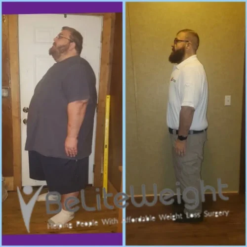 Weight Loss Surgery Before And After