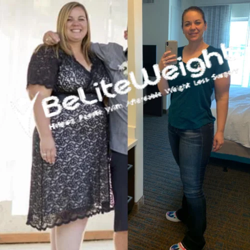 Gastric Sleeve before and after Patient - I'm extremely happy with my results!!!  I've lost 80lbs since surgery and still losing. Losing...