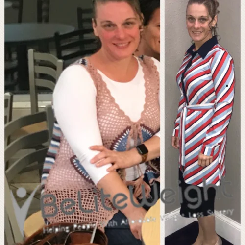 Weight Loss Surgery Before And After