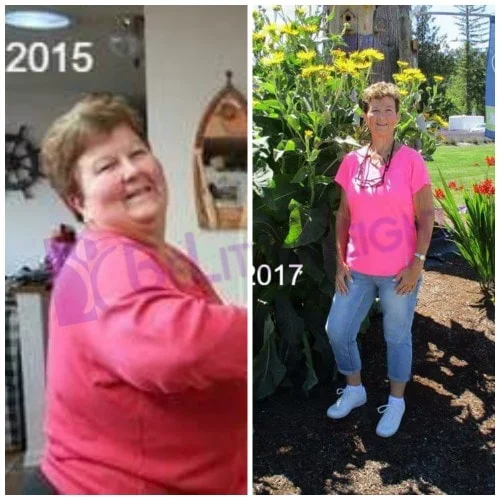 Weight Loss Surgery before and after Patient - 2 years ago today I had my Gastric Bypass Revision surgery. One of the best...