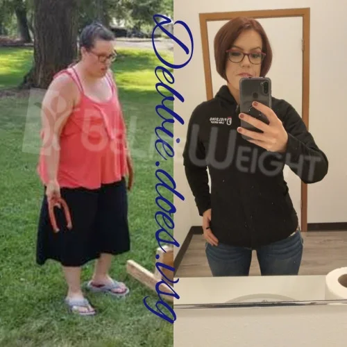 Gastric Sleeve