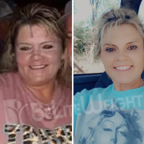 Bypass to Bypass - Complete Upper and Lower before and after Patient - Down to 140 pounds. My ribs and hip bones show now--my momma said NO MORE...