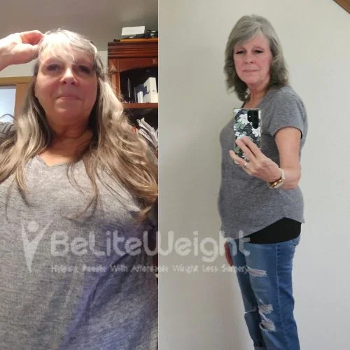 Kroeger D-gastric sleeve update after 2 years*