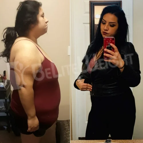 Gastric Sleeve