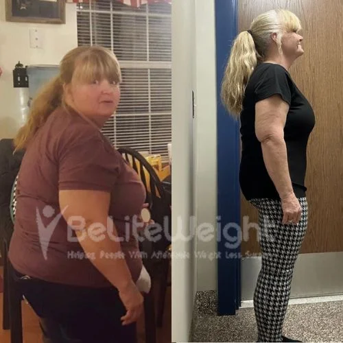 Diana. G - gastric sleeve  update after 4 years*