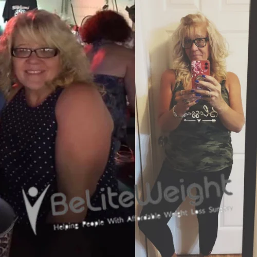 Weight Loss Surgery Before And After