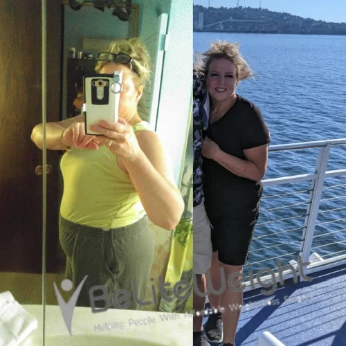 Weight Loss Surgery Before And After