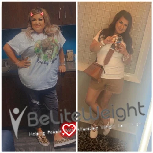 Weight Loss Surgery Gastric Sleeve before and after