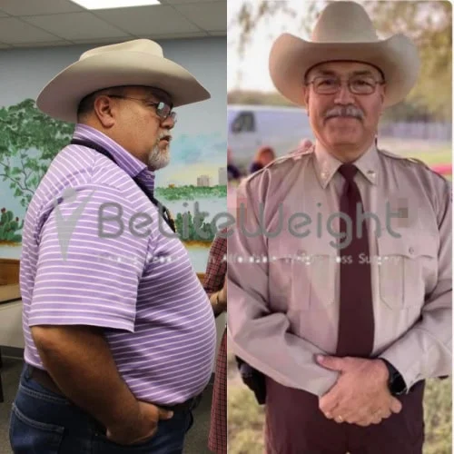 Metabolic RNY Bypass for Diabetes before and after Patient - Hello Joanne. Yes all correct, I am very pleased down 122 pounds.I am currently at...