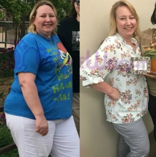 Weight Loss Surgery before and after Patient - Starting weight at time of surgery was 278 lbs and current weight is 222 lbs.Surgeons...