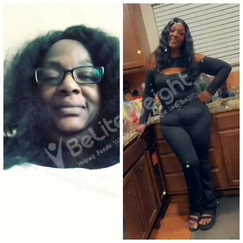 Mini Gastric Bypass before and after Patient - Down 173 poundsMini Gastric Bypass - Single Anastamosis BypassSurgeons: The surgical team of Dr. Jose...