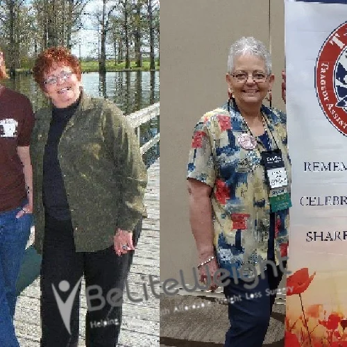 Weight Loss Surgery Gastric Sleeve before and after