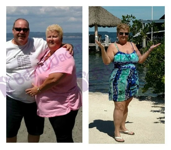 weight loss surgery vsg vertical gastric sleeve bypass mini bariatric laproscopic weight loss surger