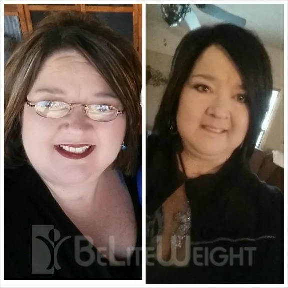 Weight Loss Surgery before and after Patient - 7 weeks and I'm down 46 lbs!!!* On the left was before. The right was...