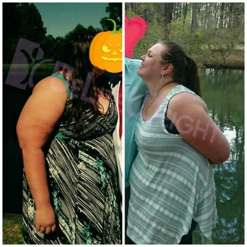 weight loss surgery vsg gastric sleeve before after photos testimonial revision after lap band