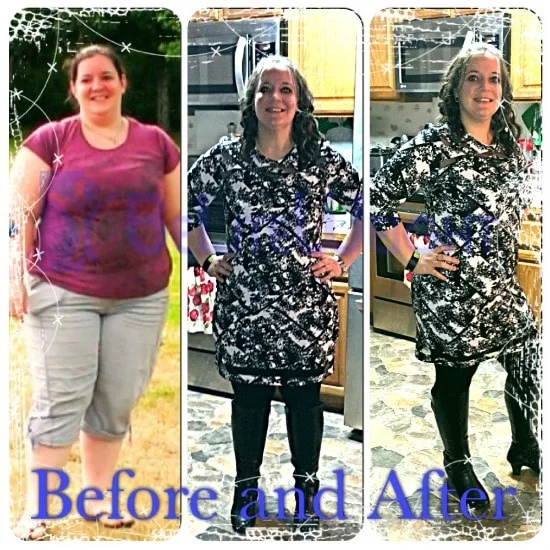 Gastric Sleeve - VSG - Vertical Sleeve Gastrectomy