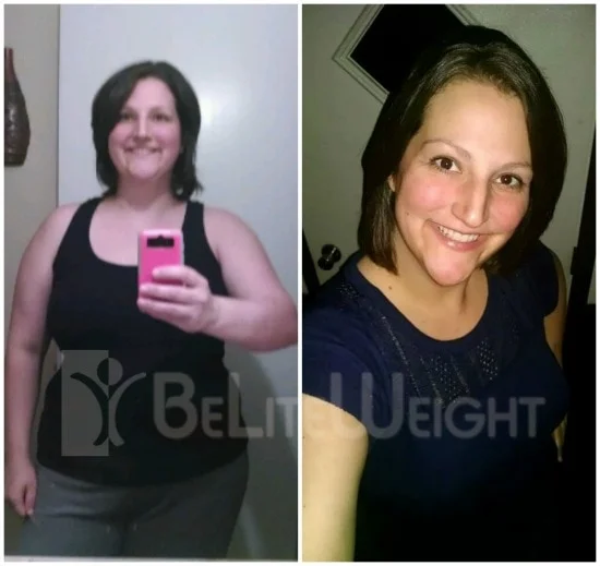 Gastric Sleeve - VSG - Vertical Sleeve Gastrectomy