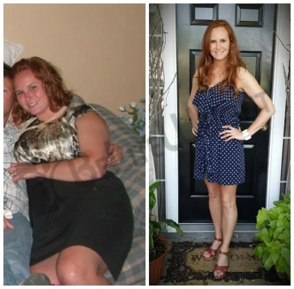 Brandy - After Gastric Sleeve Surgery