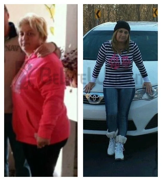 Weight Loss Surgery before and after Patient - I had my surgery at Ciudad Juarez on September, 18, 2013. I want to thank...