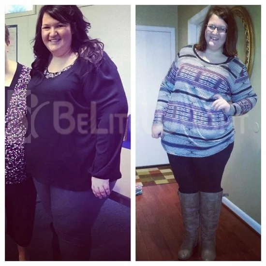Weight Loss Surgery before and after Patient - Today at two months post-op I'm so thankful that I actually had the nerve to...