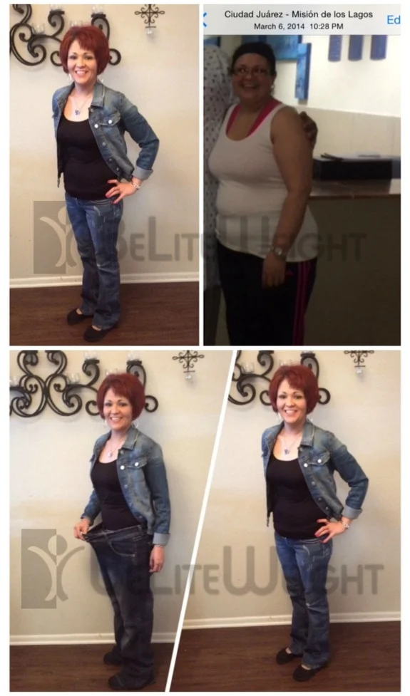 Weight Loss Surgery before and after Woman - In one year after her VSG (Vertical Sleeve Gastrectomy), Nicole went from a size 18 ...