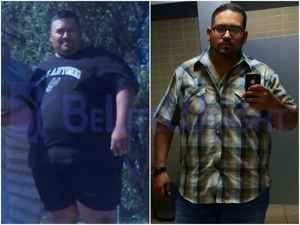 Ernesto - Gastric Sleeve Surgery Results