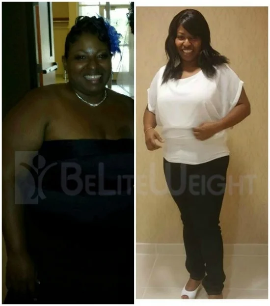 Weight Loss Surgery before and after Patient - 10 months and half my size*..thanks i feel great!Gastric Sleeve / Vertical Sleeve Gastrectomy *See below