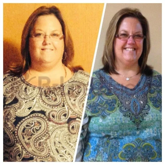 Gastric Sleeve - VSG