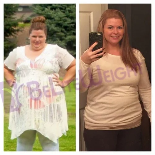 weight loss surgery success story before and after vsg gastric sleeve bariatric