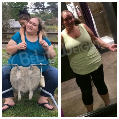 weight loss surgery vsg gastric sleeve before after photos testimonial