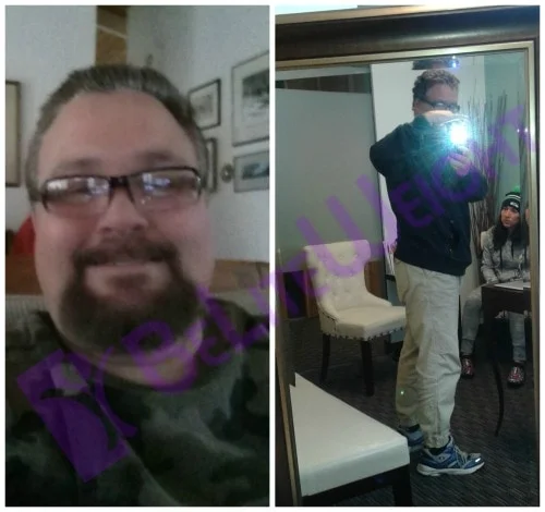 weight loss surgery before and after vsg vertical gastric sleeve bariatric