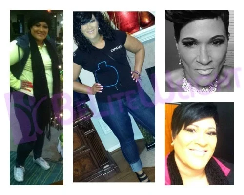 weight loss surgery vsg gastric sleeve before after photos testimonial revision after lap band