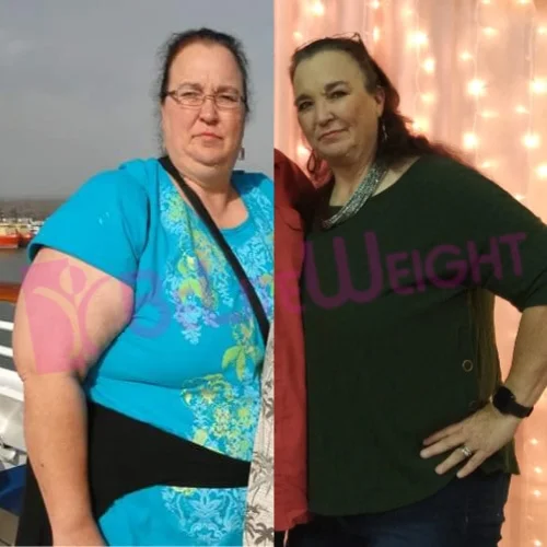 Gastric Sleeve