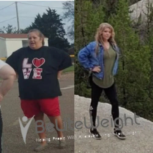 Weight Loss Surgery Gastric Sleeve before and after