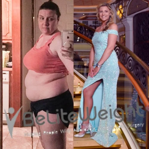 Weight Loss Surgery Gastric Sleeve before and after