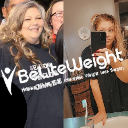 Plication to RNY Bypass Revision before and after Patient - It's been the best experience of my life...just wish I would of done it sooner!!Plication...