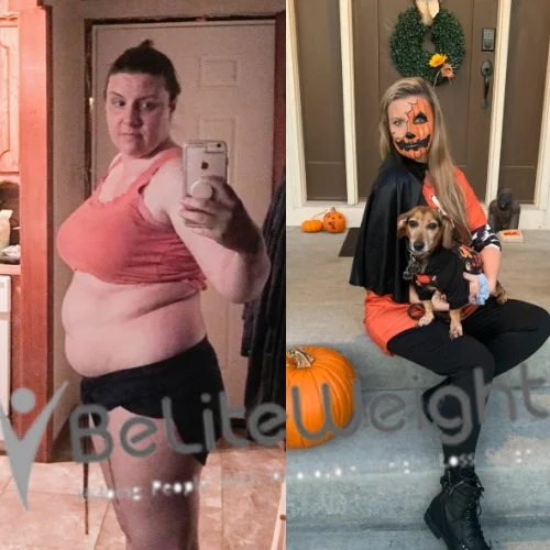 Weight Loss Surgery Gastric Sleeve before and after