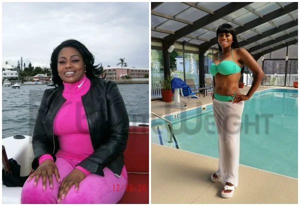 Hope - Before and After VSG Surgery