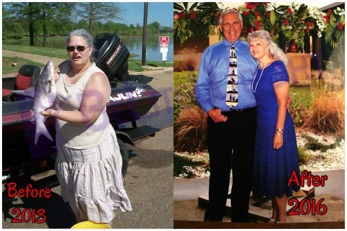 weight loss surgery before and after vsg vertical gastric sleeve