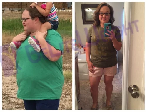 weight loss surgery before and after gastric bypass sleeve vsg