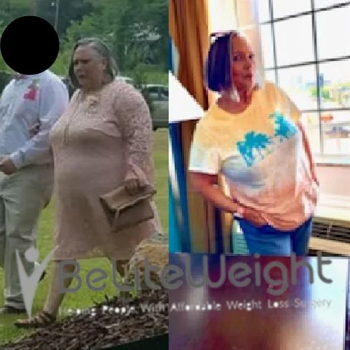 Weight Loss Surgery Before And After
