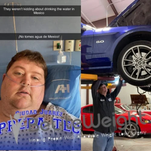 Weight Loss Surgery Before And After