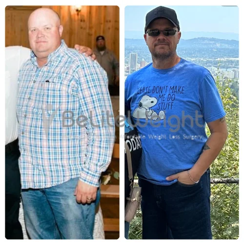 RNY Gastric Bypass before and after Patient - Surgery on 3-11-2023 till now - Has lost 130 pounds.RNY Gastric BypassSurgeons: The surgical team...